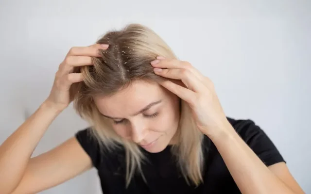How Your Diet Can Help Prevent Dandruff: Essential Nutrients for a Healthy Scalp